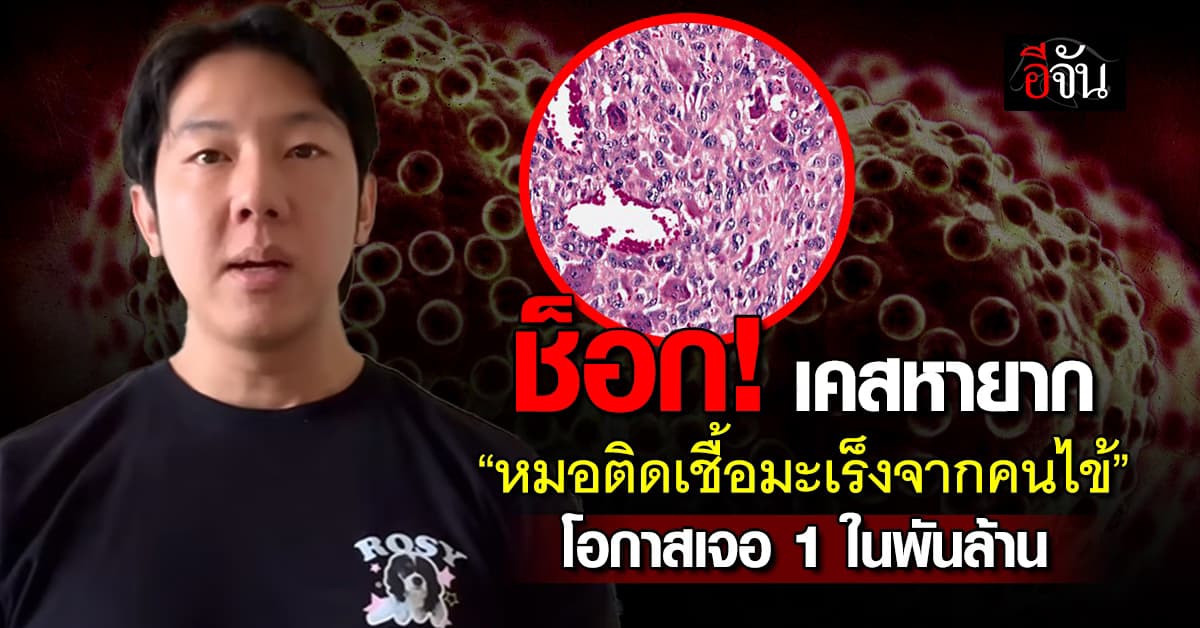 นพ.ธนีย์ เล่าเคสสุดช็อกวงการแพทย์ “หมอติดเชื้อมะเร็งจากคนไข้” – เผยโอกาสเจอ 1 ในพันล้าน