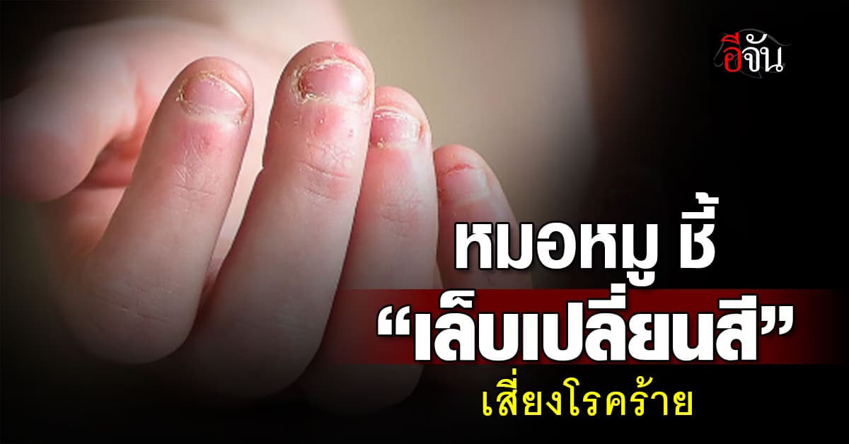 หมั่นสังเกต! หมอหมู ชี้ “เล็บเปลี่ยนสี” สัญญาณบอกโรคร้าย