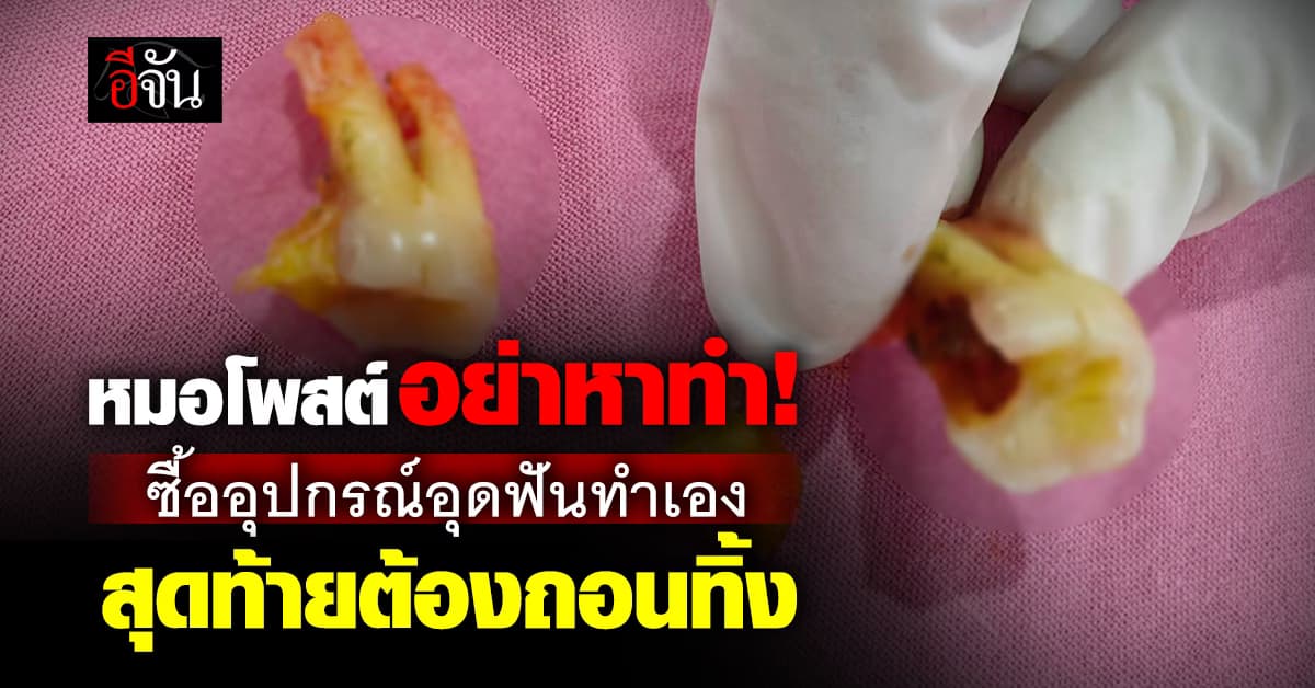 อย่าหาทำ! หมอโพสต์เตือน ซื้ออุปกรณ์อุดฟันจาก TikTok สุดท้ายต้องถอนทิ้ง