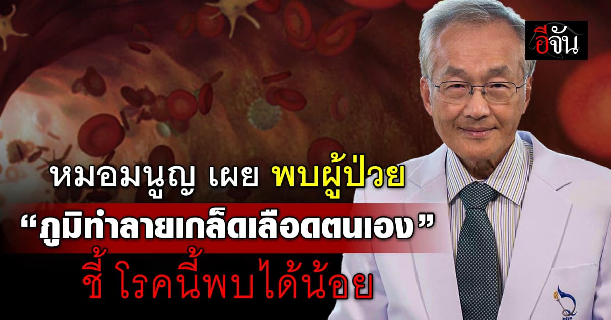 หมอมนูญ เผย พบผู้ป่วย “ภูมิทำลายเกล็ดเลือดตนเอง” ชี้โรคนี้พบได้น้อย