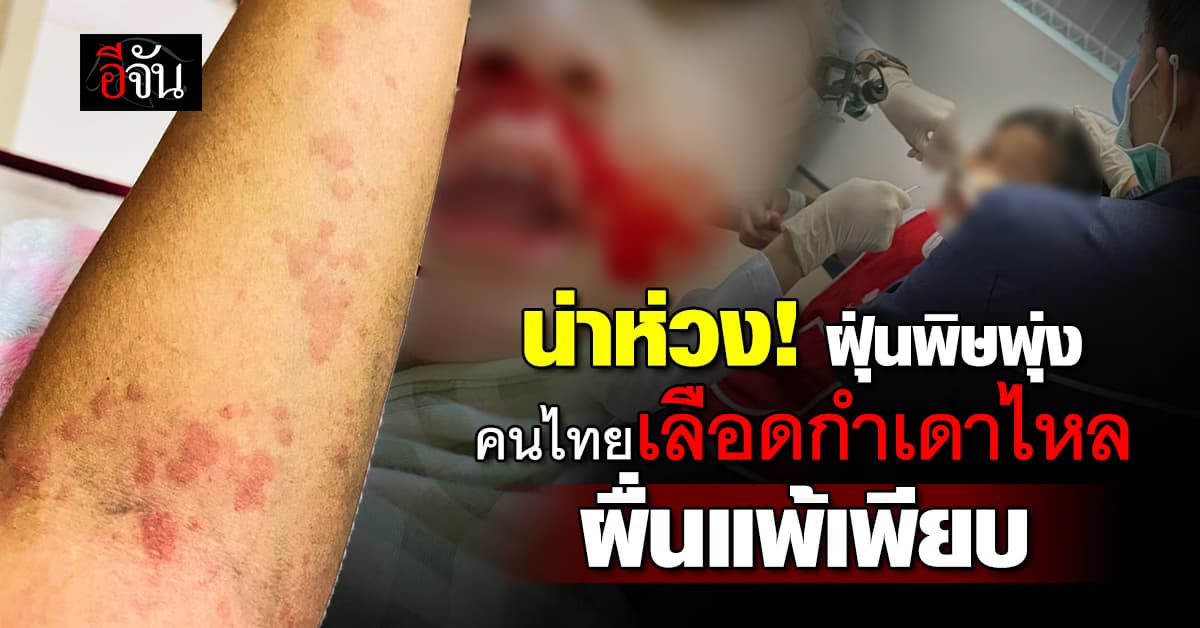 น่าห่วง! ฝุ่นพิษ PM 2.5 พุ่ง หลายคนเลือดกำเดาไหล-ผื่นแพ้เพียบ 