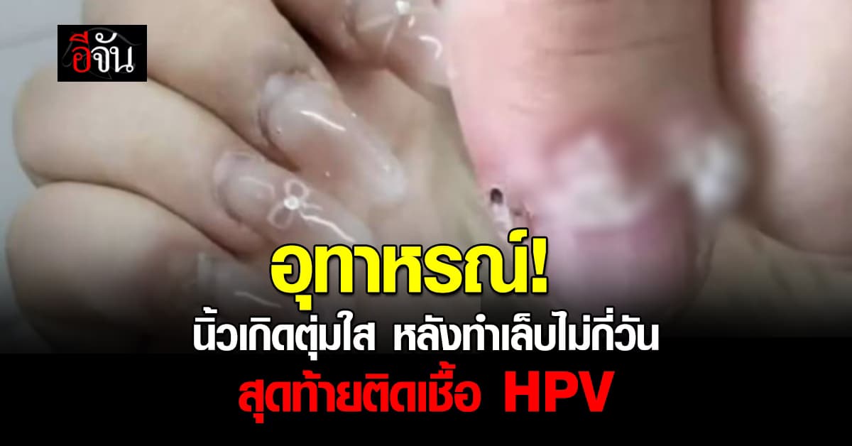 อุทาหรณ์! สาวเผยไปทำเล็บไม่กี่วัน นิ้วเกิดตุ่มใสบวมเป่ง สุดท้ายติดเชื้อ HPV
