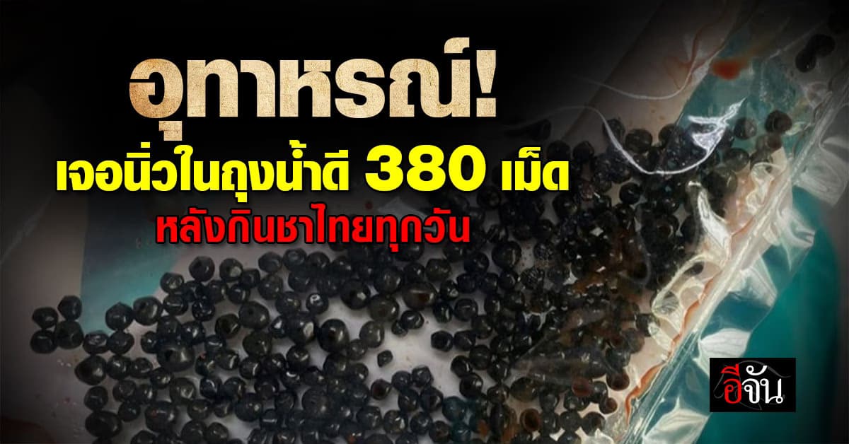 พยาบาลสาว ยกเคสเตือน! เจอนิ่วในถุงน้ำดี 380 เม็ด หลังกินชาไทยทุกวัน 