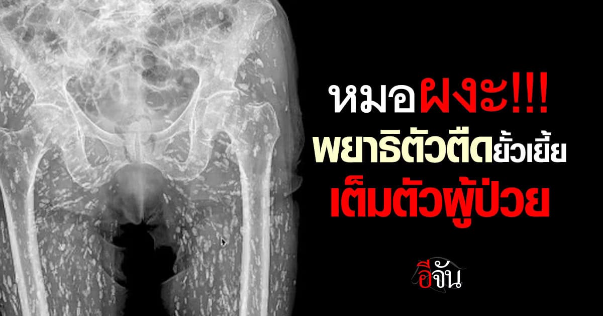 ผงะ! หมอแทบช็อก ภาพเอกซเรย์พบ “พยาธิตัวตืดยั้วเยี้ย” เต็มตัวผู้ป่วย