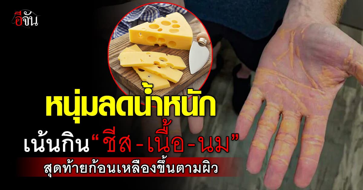 อย่าหาทำ! หนุ่มสหรัฐฯ ใช้สูตรลดน้ำหนัก เน้นกิน “ชีส-เนื้อ-นม” นาน 8 เดือน สุดท้ายก้อนเหลืองขึ้นตามผิว