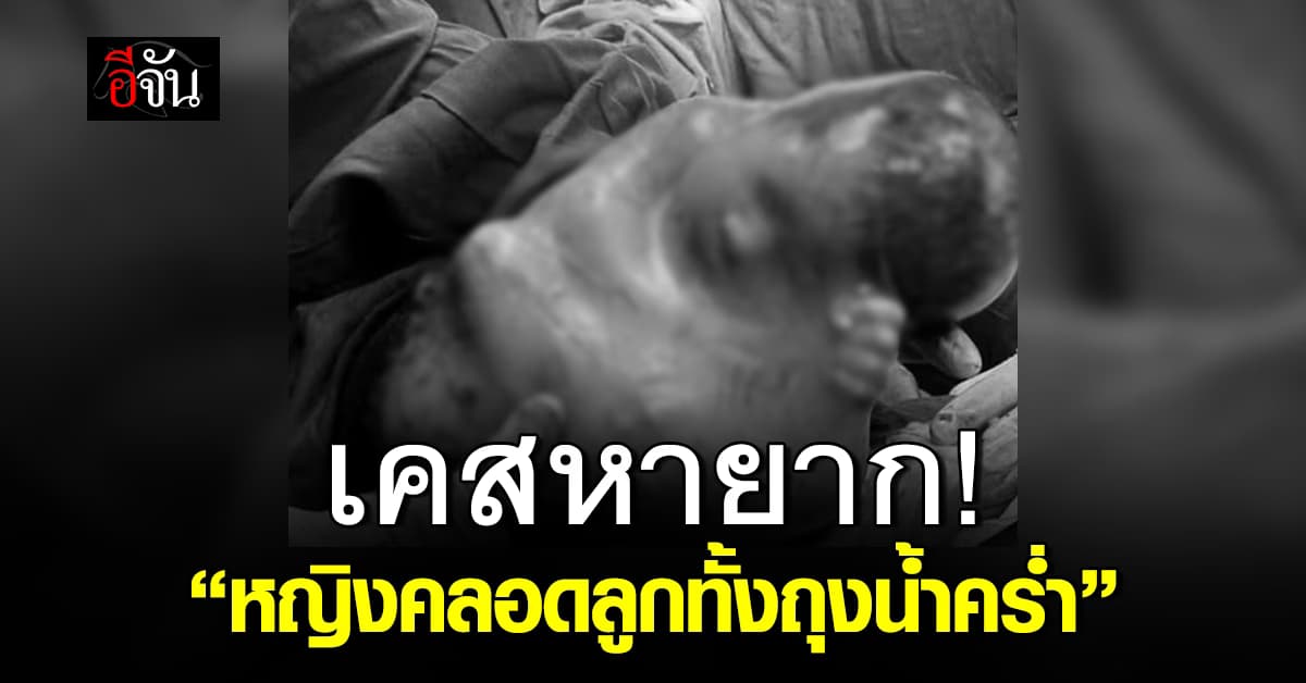 อึ้ง! หญิงเวียดนามคลอดลูก ทั้งที่อยู่ใน “ถุงน้ำคร่ำ” – แพทย์ชี้เคสหายาก