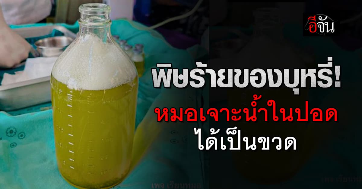 พิษร้ายของบุหรี่! หมอเจาะน้ำในปอดได้เป็นขวด คิดดูว่าจะทรมานแค่ไหน?