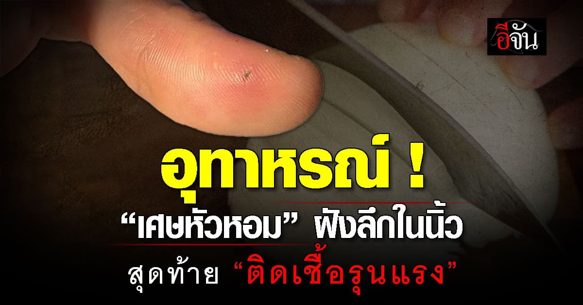 คาดไม่ถึง! สาวเตือนอุทาหรณ์ “เศษหัวหอม” ฝังลึกในนิ้ว สุดท้าย “ติดเชื้อรุนแรง”