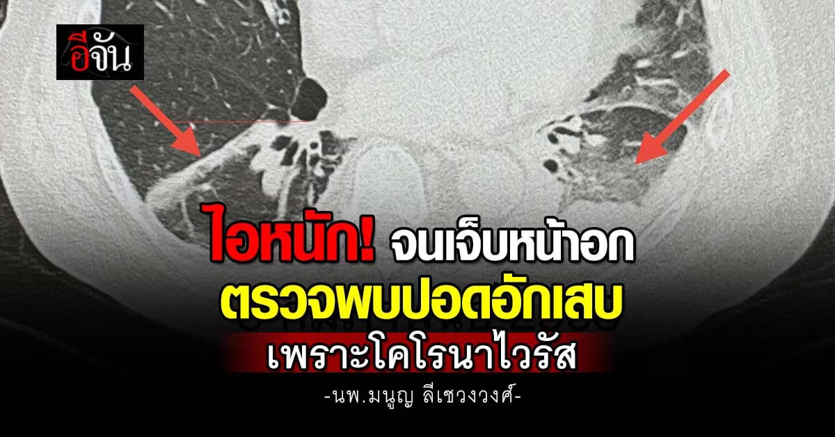 หมอยกเคส เตือน! ผู้ป่วยวัย 64 ปี ไอหนักจนเจ็บหน้าอก ตรวจพบปอดอักเสบ เพราะโคโรนาไวรัส 