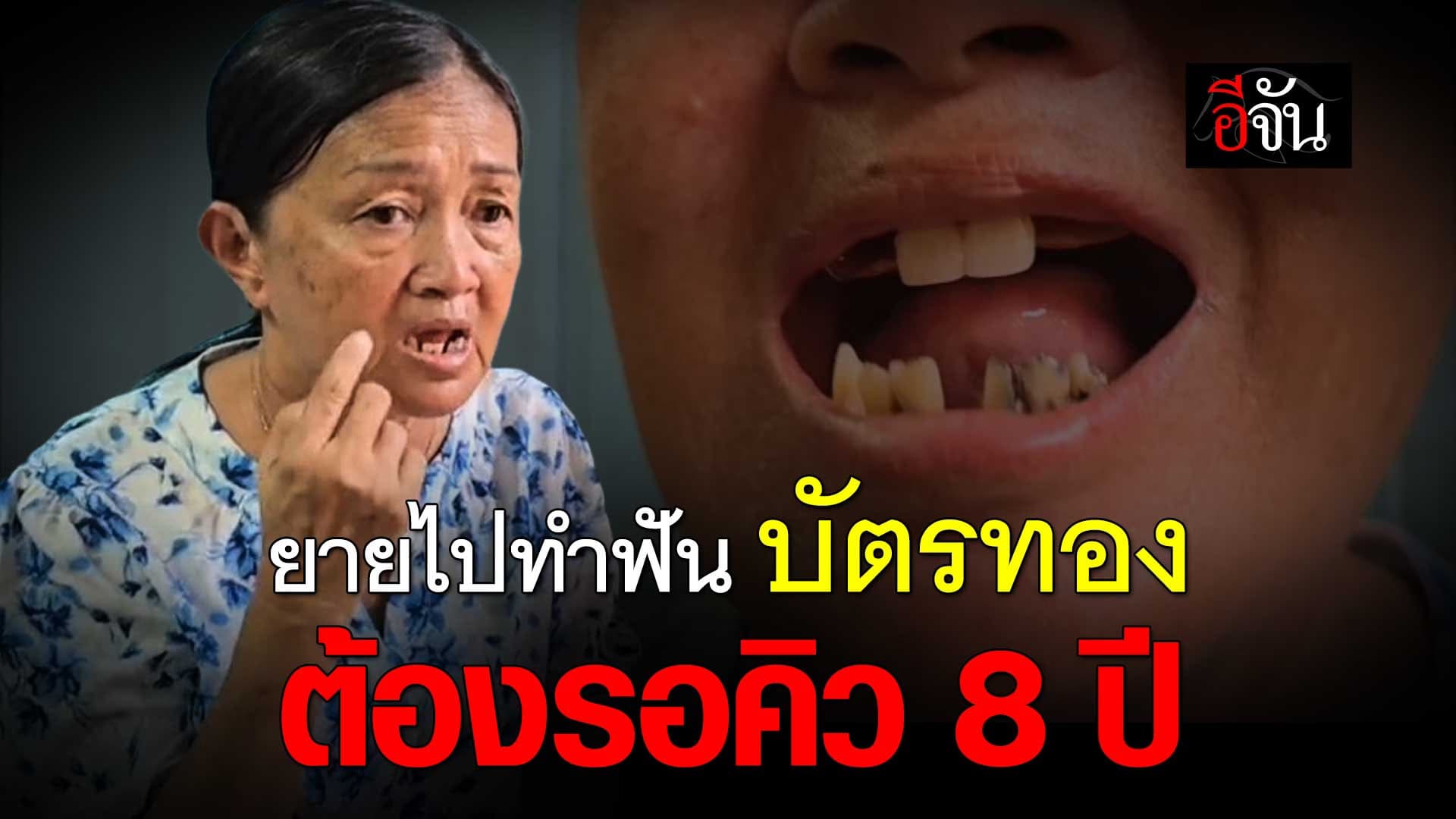 🎬 ยายไปทำฟัน ใช้สิทธิ์ บัตรทอง ต้องรอคิว 8 ปี