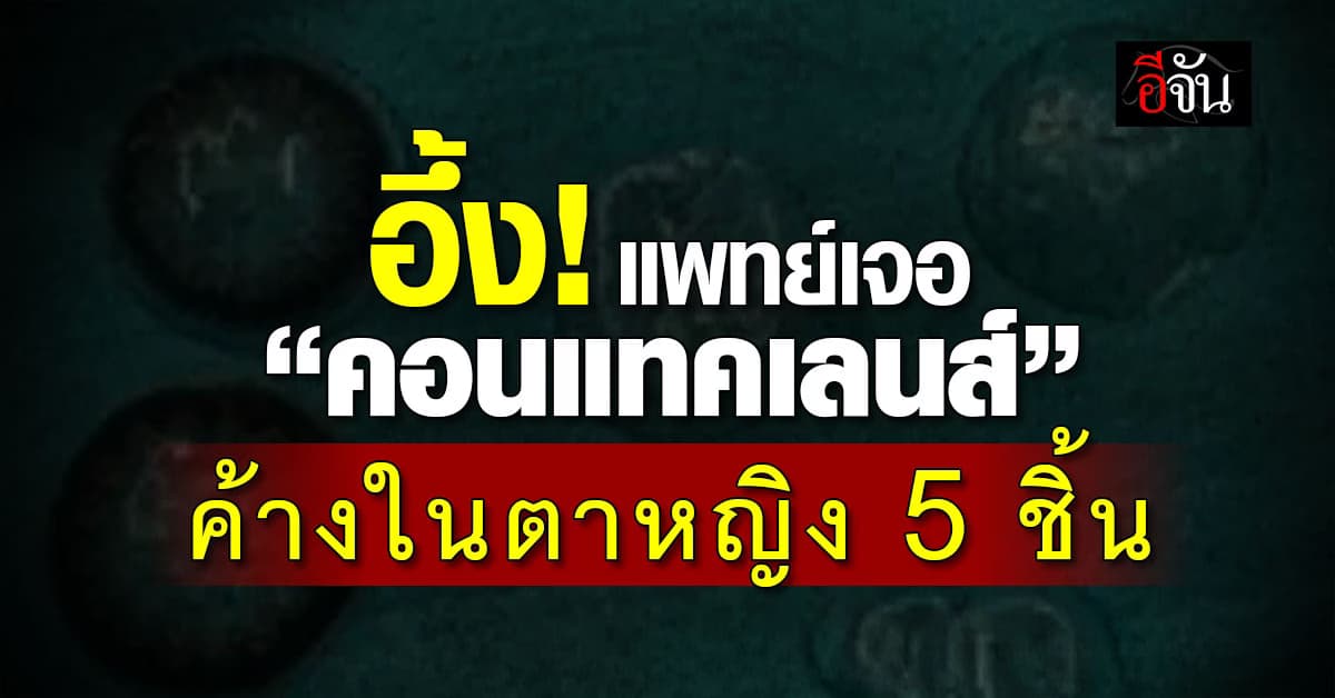 หลุดได้ไง! แพทย์จีนอึ้ง เจอ “คอนแทคเลนส์” หลุดเข้าดวงตาหญิงถึง 5 ชิ้น