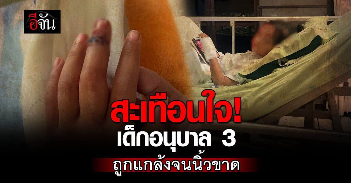 สะเทือนใจ! ผู้ปกครองร้อง หลานอนุบาล 3 ถูกเพื่อนแกล้งจน “นิ้วขาด”
