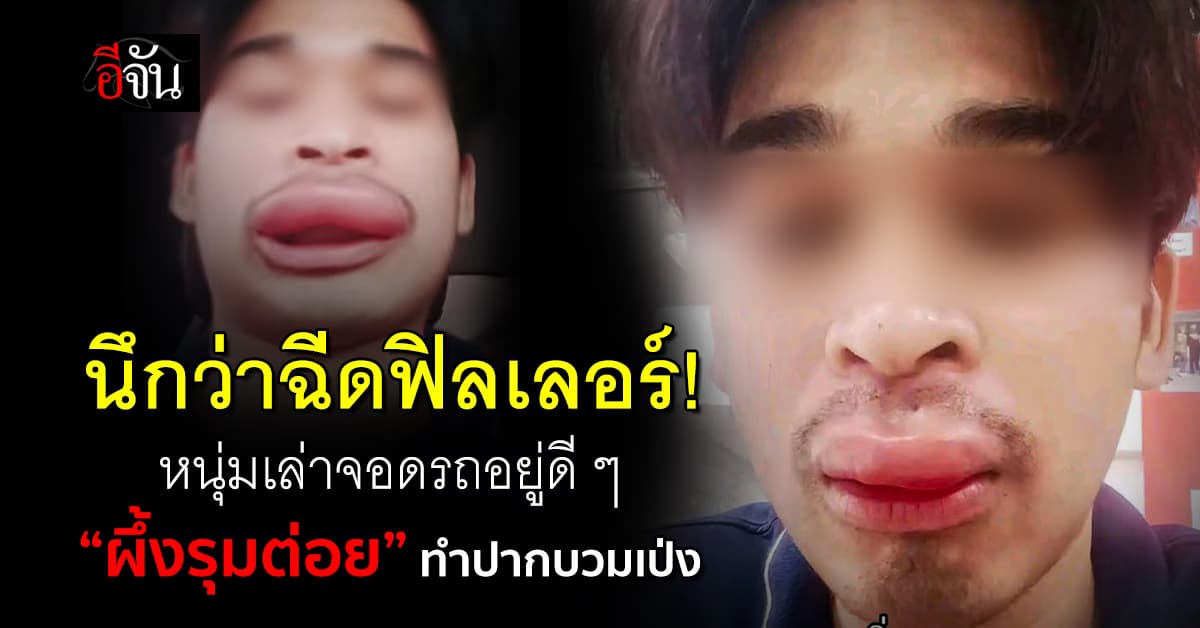 นึกว่าฉีดฟิลเลอร์! หนุ่มโพสต์จอดรถอยู่ดี ๆ “ผึ้งบินต่อย” ทำปากบวมเป่ง