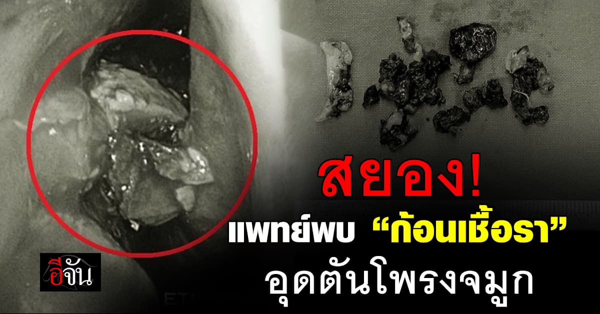 ขนลุก! แพทย์ไต้หวันพบ “ก้อนเชื้อรา” อุดตันโพรงจมูกหญิง