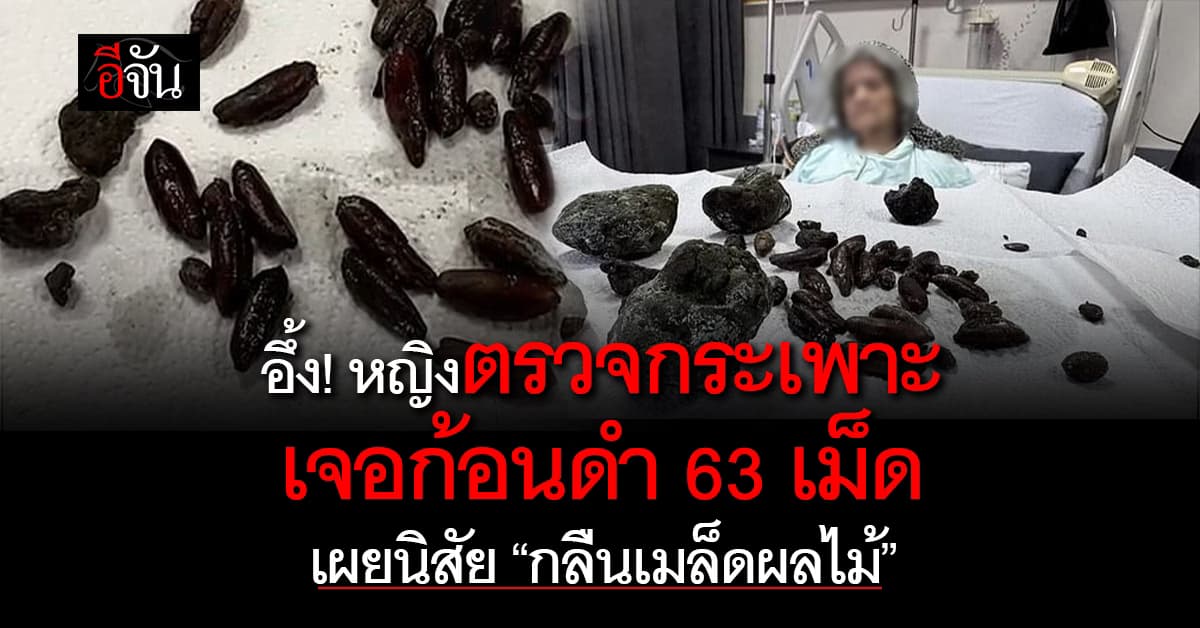 เลิกได้เลิก! หญิงชราตรวจกระเพาะ “เจอก้อนดำ 63 เม็ด” เผยนิสัย “ชอบกลืนเมล็ดผลไม้”