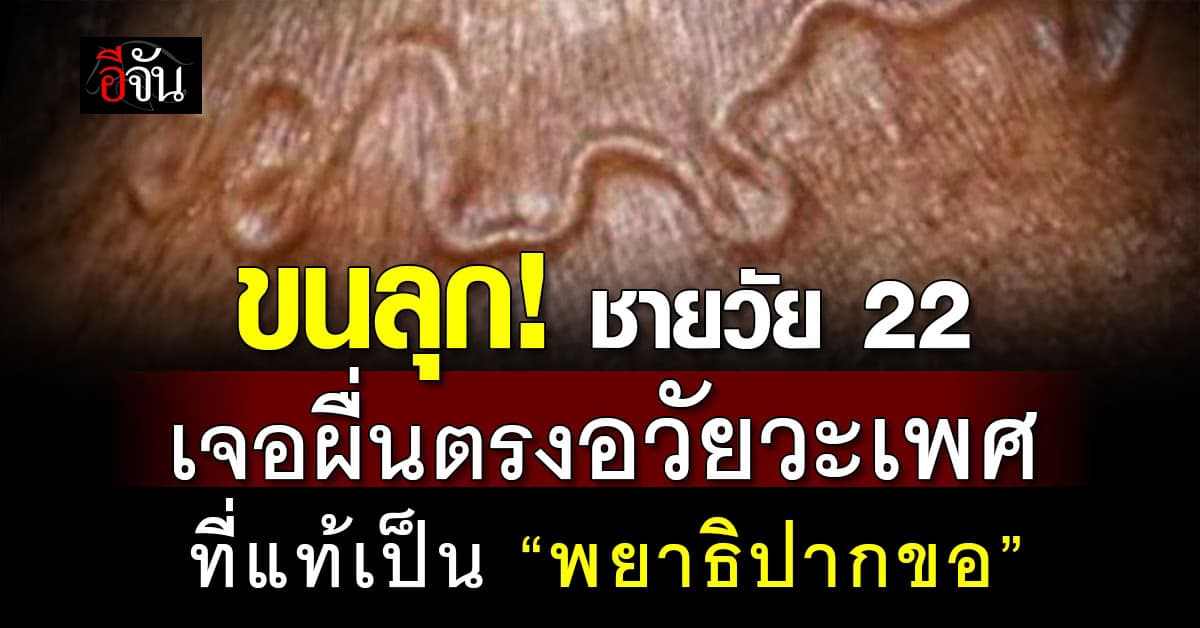 ขนลุก! ชายวัย 22 เจอผื่นตรงอวัยวะเพศ ที่แท้เป็น “พยาธิปากขอ”