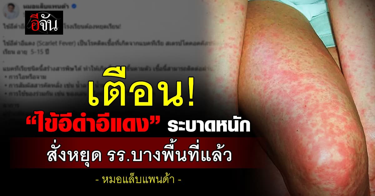 หมอแล็บแพนด้า เตือน! “ไข้อีดำอีแดง” ระบาดหนักหลายโรงเรียน