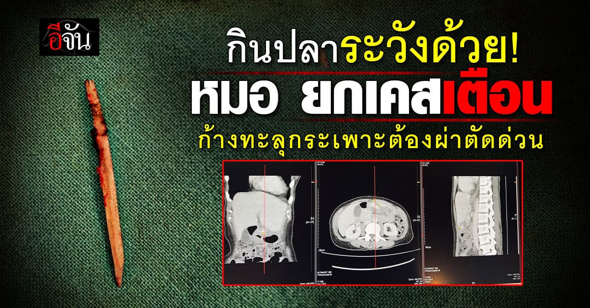 กินปลาระวังด้วย! หมอ ยกเคสเตือน ก้างปลาทะลุกระเพาะ ต้องผ่าตัดด่วน 