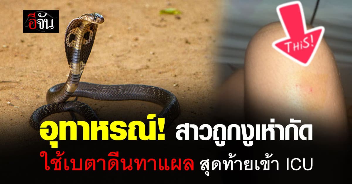 อย่าหาทำ! สาวเตือนอุทาหรณ์ถูกงูเห่ากัด ใช้เบตาดีนทาแผล สุดท้ายเข้า ICU