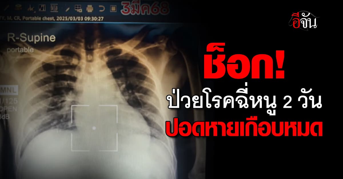 ช็อก! เปิดภาพเอกซเรย์ ผู้ป่วยโรคฉี่หนู 2 วัน ปอดหายเกือบหมด