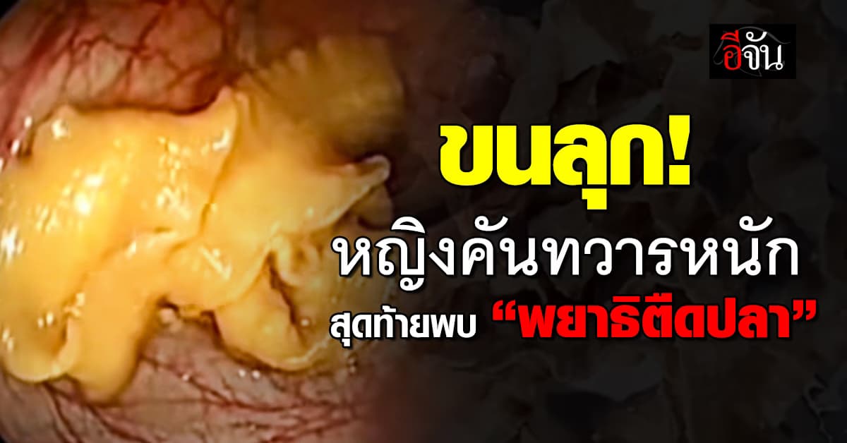 ถึงกับขนลุก! หญิงวัย 46 ปี คันทวารหนัก แพทย์ส่องพบ “พยาธิตืดปลา” ในลำไส้