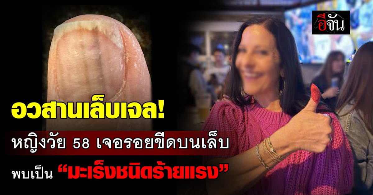 อุทาหรณ์! หญิงวัย 58 พบรอยปริศนาบนเล็บ เอะใจรีบพบแพทย์ สุดท้ายพบ “มะเร็งผิวหนังชนิดร้ายแรง” 
