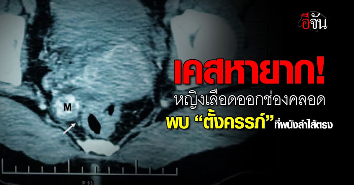 เคสหายาก! หญิงเกิดเลือดออกช่องคลอด ก่อนพบ “ตั้งครรภ์” ที่ผนังลำไส้ตรง