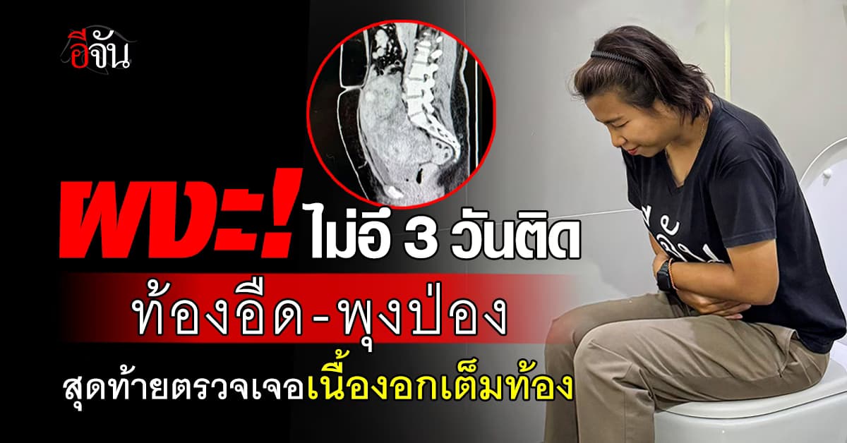 อุทาหรณ์! สาวถ่ายไม่ออก 3 วันติด ท้องอืดพุงป่อง สุดท้ายตรวจเจอ “เนื้องอกเต็มท้อง” 
