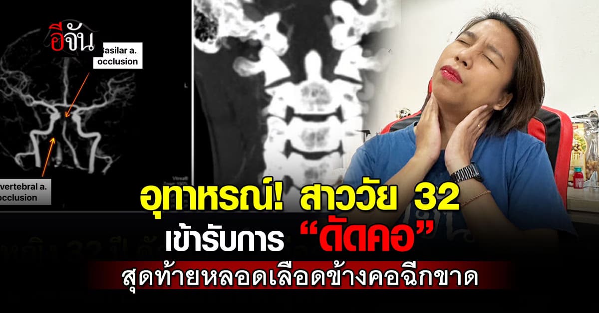 อย่าหาทำ! สาววัย 32 ปี เหงื่อแตก-หัวใจหยุดเต้น หลังไป “ดัดคอ” สุดท้ายหลอดเลือดข้างคอฉีกขาด  