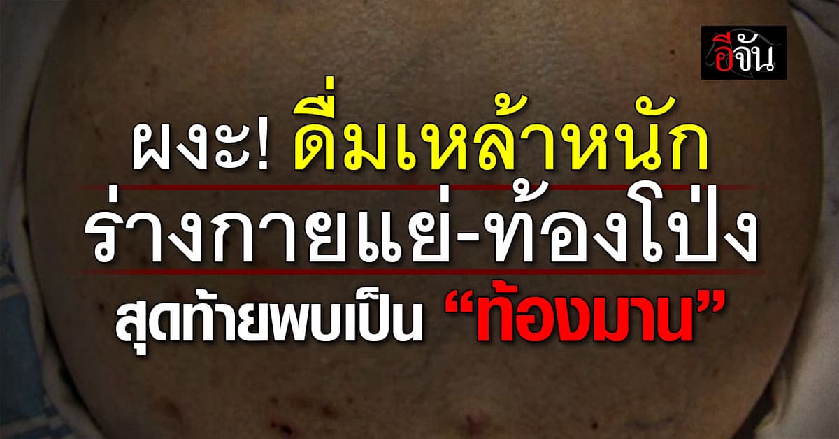 นักดื่มยั้งมือ! ผู้ป่วยรายหนึ่ง ร่างกายแย่-ท้องโป่งขึ้น หลังดื่มเหล้าหนัก สุดท้ายตรวจพบเป็น“ท้องมาน”  