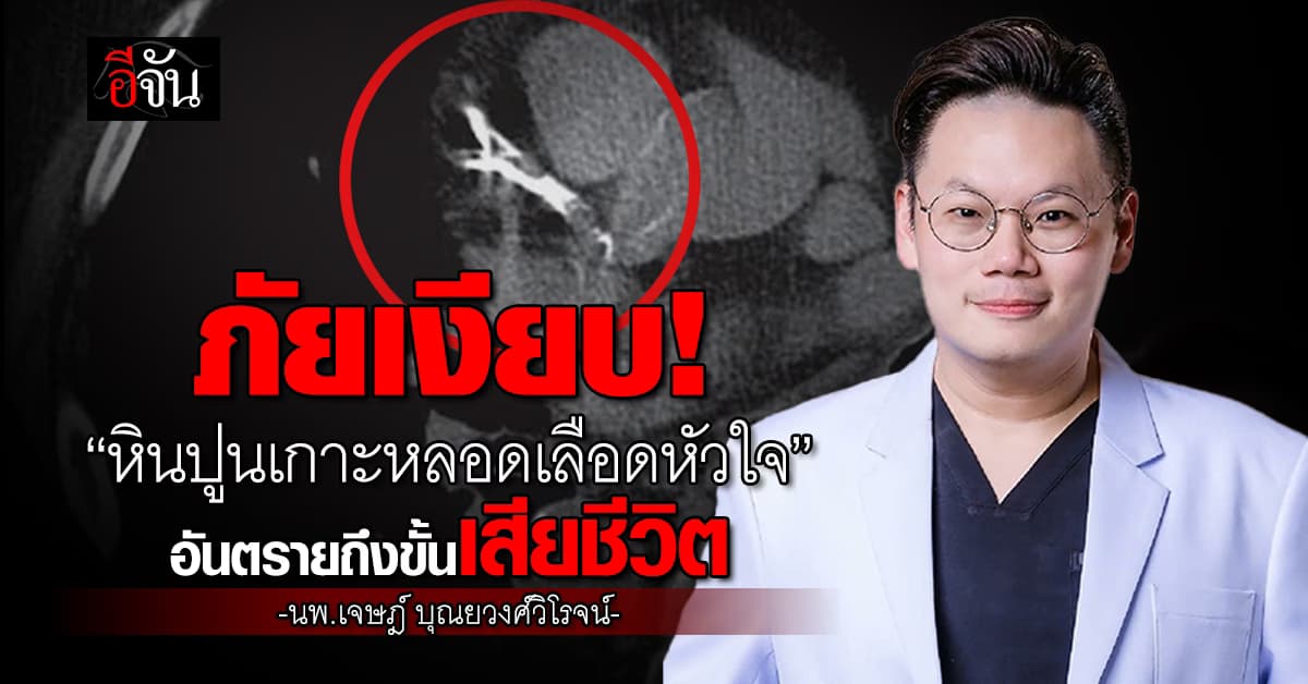ภัยเงียบที่ต้องระวัง! “หมอเจด” โพสต์เตือน“หินปูนเกาะหลอดเลือดหัวใจ” อาจถึงตาย