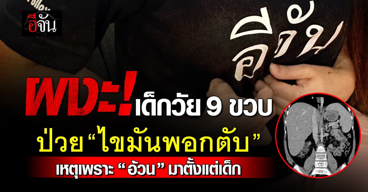 น่าตกใจ! เด็กวัย 9 ขวบ มีค่า BMI สูง สุดท้ายพบเป็น “ไขมันพอกตับ”  