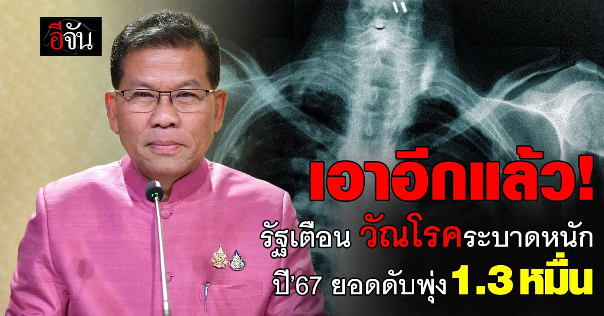 รัฐฯ เตือน ‘วัณโรค’ ระบาดหนัก ปี 67 ยอดดับพุ่ง 1.3 หมื่นราย