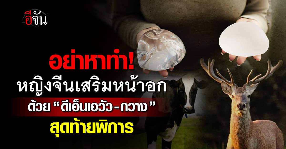 อุทาหรณ์! หญิงจีนเสริมหน้าอก ผสม “ดีเอ็นเอวัว-กวาง” สุดท้ายพิการ
