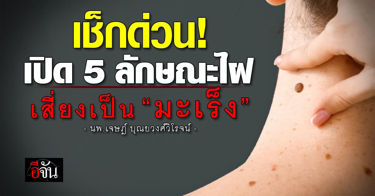 ของใกล้ตัว! หมอเจด โพสต์เตือน 5 ลักษณะไฝ อาจเสี่ยงเป็น “มะเร็ง”