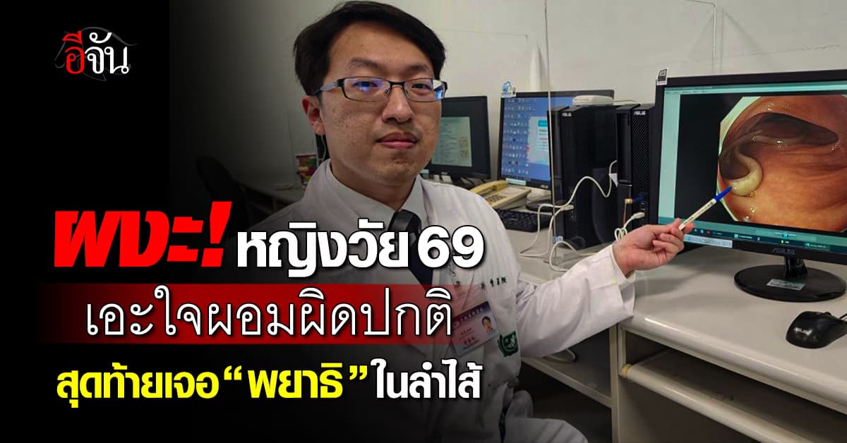 ผงะ! หญิงวัย 69 เอะใจน้ำหนักลดผิดปกติ สุดท้ายพบ “พยาธิ” ยั้วเยี้ยในลำไส้