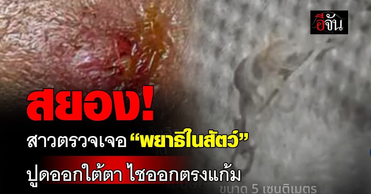 สาวมีตุ่มบริเวณใบหน้า ตรวจเจอ “พยาธิในสัตว์” ปูดออกใต้ตา ไชออกตรงแก้ม   