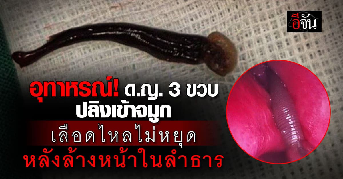 เล่นน้ำระวังด้วย! ด.ญ. 3 ขวบ เลือดกำเดาไหลไม่หยุด 4 วันติด หลังล้างหน้าในลำธาร 