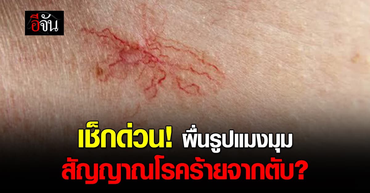 พักตับบ้างนะสายดริ๊งก์! เช็กร่างกายด่วน “ผื่นรูปแมงมุม” อาจเป็นสัญญาณเตือนโรคร้ายจากตับ 