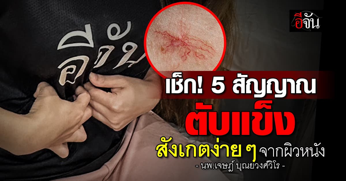 หมอเจด เผย 5 สัญญาณเตือน “โรคตับแข็ง” สังเกตง่ายๆ จากอาการทางผิวหนัง ที่หลายคนมักมองข้าม 