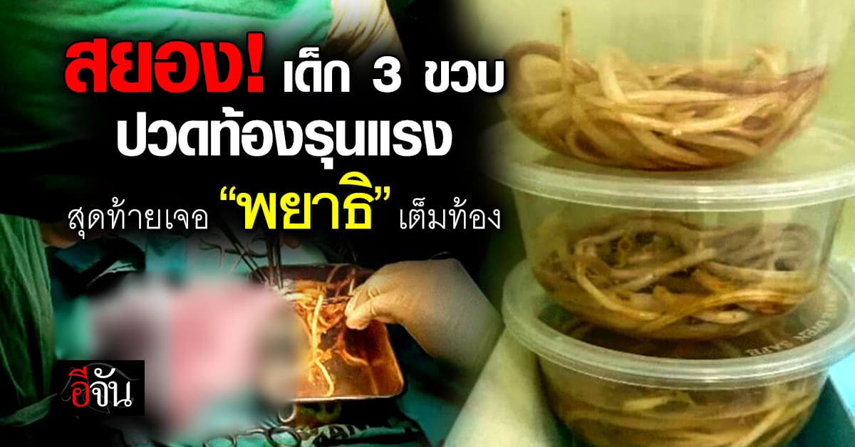 สยอง! เด็กชาย 3 ขวบ ปวดท้องรุนแรง สุดท้ายเจอ “พยาธิตัวกลม” ยั้วเยี้ยเต็มท้อง