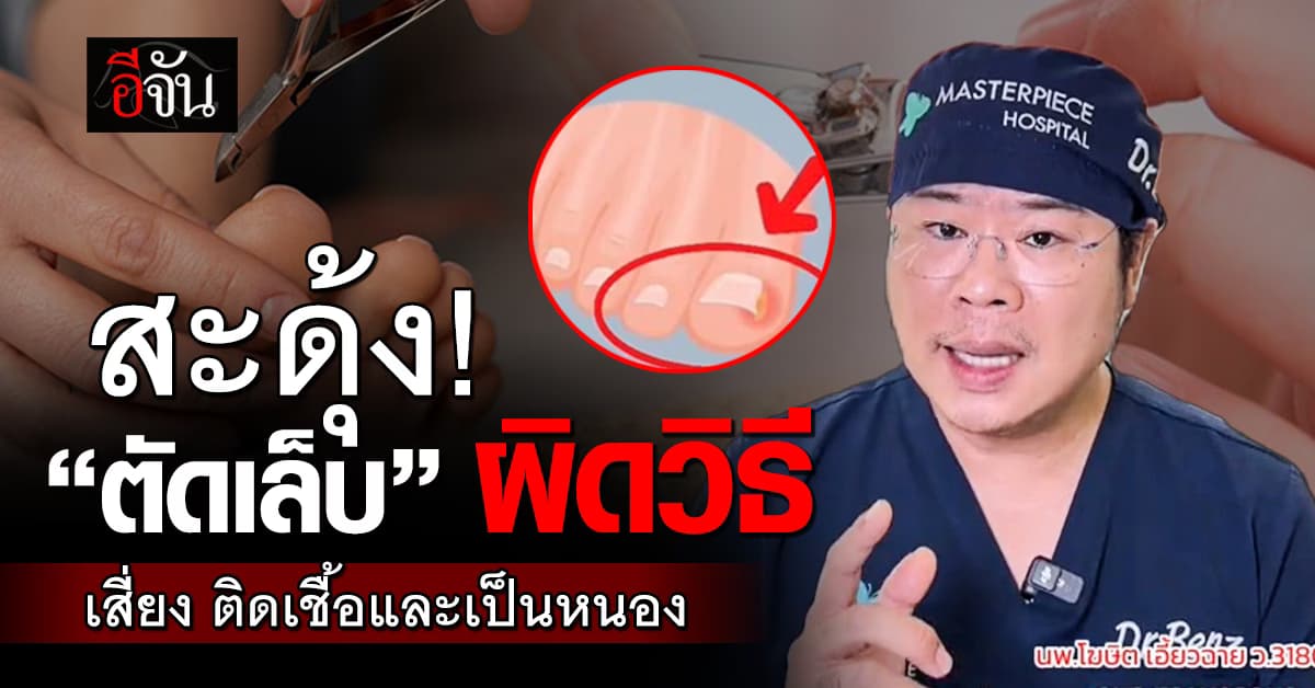 รู้ไว้ไม่เสียหาย! “ตัดเล็บ” ผิดวิธี เสี่ยงติดเชื้อและเป็นหนองได้
