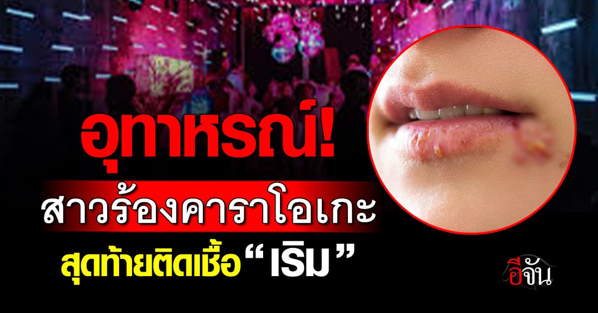 อุทาหรณ์! สาวร้องคาราโอเกะ สุดท้ายติดเชื้อ “เริม” 8 ปี รักษาไม่หาย