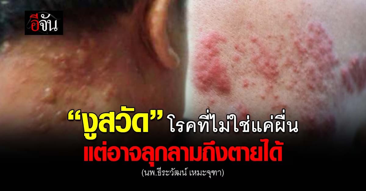 “งูสวัด” โรคที่ไม่ได้มีแค่ผื่นที่ตัว แต่อาจลุกลามถึงตายได้  