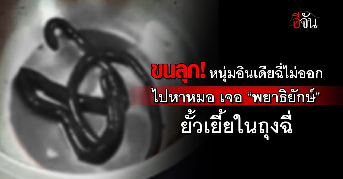 สยอง! หนุ่มอินเดียฉี่ไม่ออก ไปหาหมอ เจอ “พยาธิยักษ์” ยาวเกือบเมตร 
