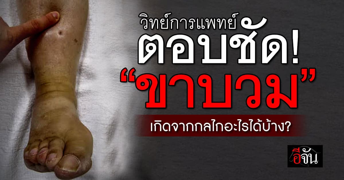 ไขข้อสงสัย? การเกิด “ขาบวม” เกิดจากกลไกอะไรได้บ้าง?