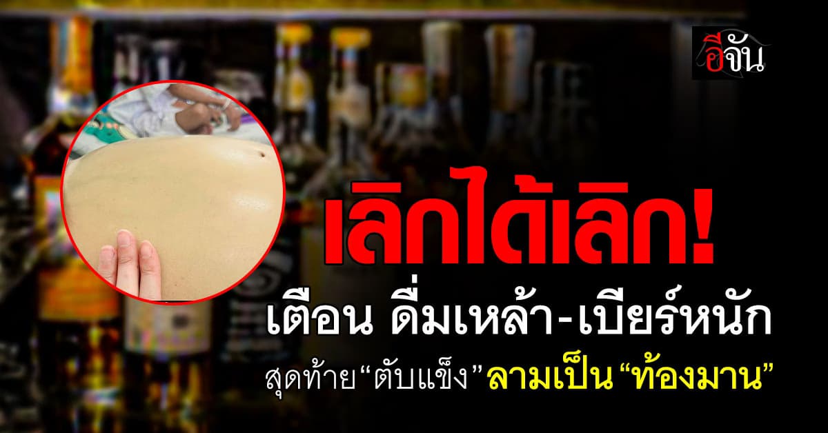 หมอ เตือน! ดื่มเหล้า-เบียร์หนัก เสี่ยง “ตับแข็ง” ลามเป็น “ท้องมาน” 