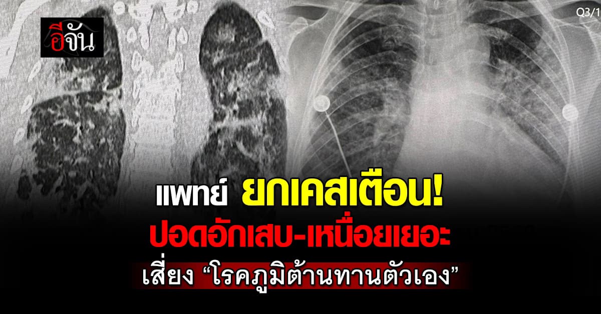 เตือน! หญิง63 เหนื่อยเยอะ–ปอดอักเสบ พบเป็น “โรคภูมิต้านทานตัวเอง”  