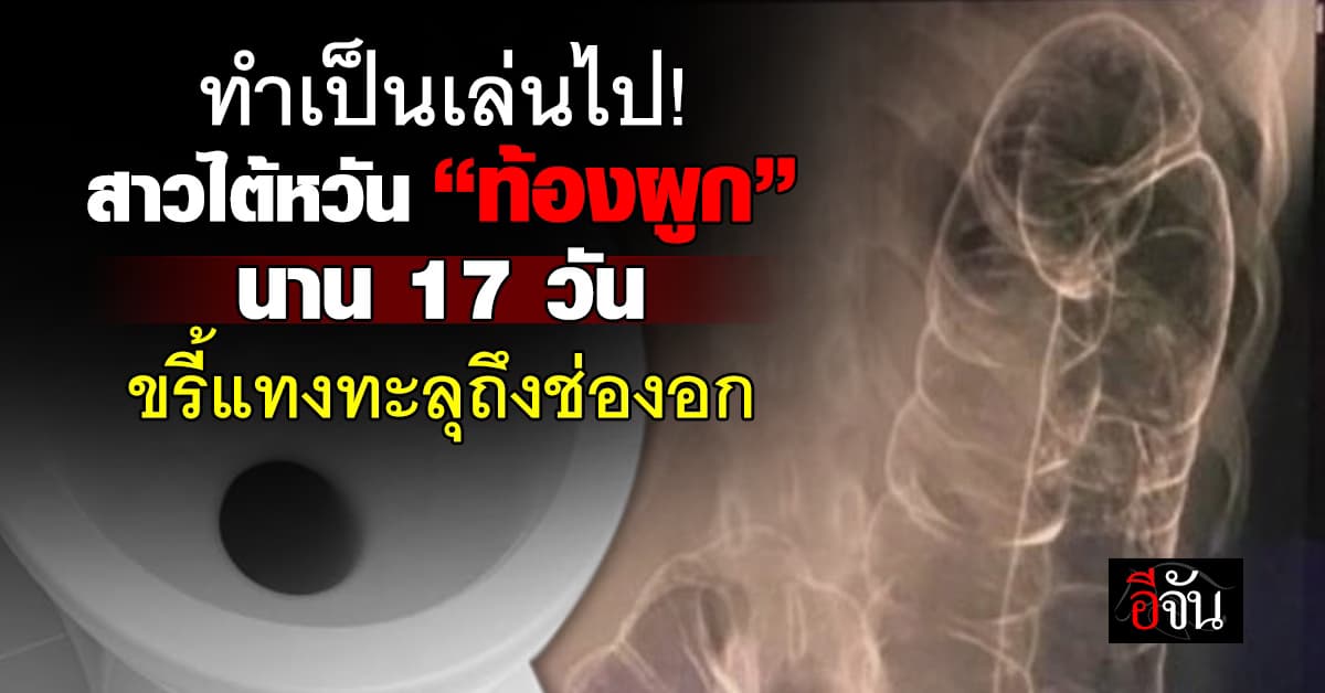 เตือน! สาวไต้หวัน ท้องผูก 17 วัน ทำขรี้สะสมดันลำไส้ทะลุถึงอก  