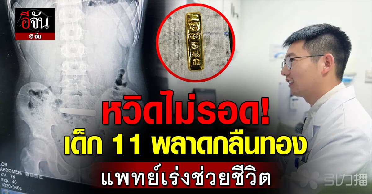 อุทาหรณ์! เด็กจีนวัย 11 เผลอกลืนทอง แพทย์เร่งช่วยชีวิตได้ทัน